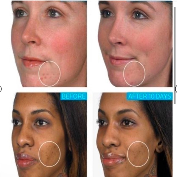 40ml La Roche-Posay Effaclar Duo Dual Action Acne Treatment- Jumbo XL Size - Picture 3 of 6